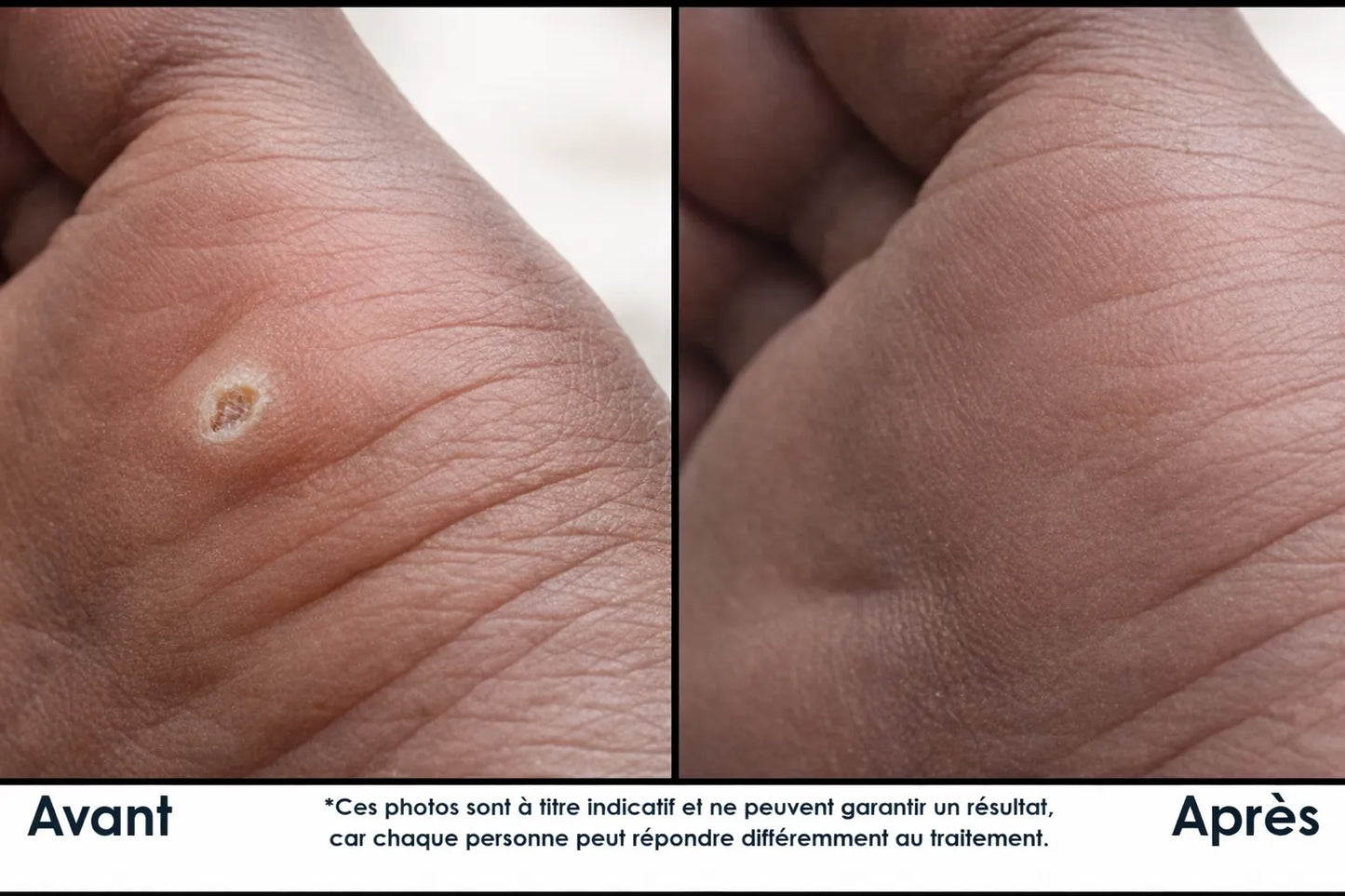 🌿 Crème Anti-Verrues – Retrouver une peau nette, sans complexe