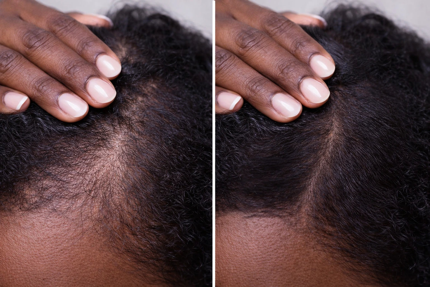 JAYSUING Shampooing à l’Ail Anti-Pelliculaire & Anti-Chute